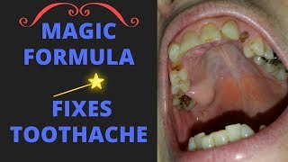 Relieve severe toothache with this magical formula GUARANTEED [upl. by Acirderf]