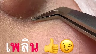 กดสิว blackheads filaments on nose remove with tweezers [upl. by Nennek]