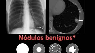 Nódulo pulmonar calcificado [upl. by Moule508]