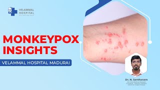 Monkeypox Insights  Doctor Talks  Infectious Diseases  Velammal Multispeciality  Madurai [upl. by Korney131]