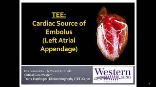 Transesophageal Echocardiography  Left Atrial Appendage Thrombus [upl. by Noiro]