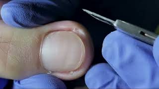 Ingrown Toenail Removal  Pedicure Treatment and Very Satisfying  Best Satisfying Nail Cutting [upl. by Aynas]