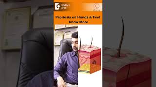 PSORIASIS on Hands amp Feet Palmoplantar Psoriasis TreatmentDrRajdeep MysoreDoctors Circleshorts [upl. by Alyehs]