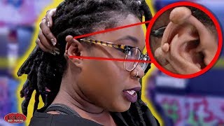 IF YOU HAVE A KELOID YOU NEED TO WATCH THIS [upl. by Gnilrits]