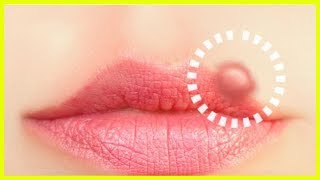 10 Naturheilmittel gegen Lippenherpes [upl. by Niwle182]