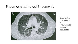 Pneumocystis Jirovecii Pneumonia [upl. by Nazay505]