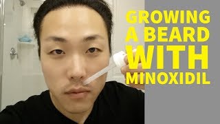 Can Asians Grow Beards With Minoxidil [upl. by Nyleek]