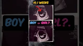 baby boy or baby girl10 weeks ultrasound 💜💙🤰shorts genderreveal baby ultrasound [upl. by Eeryt]