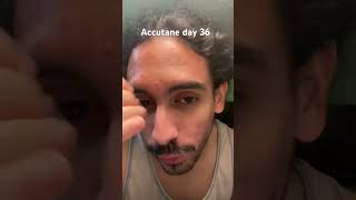 Accutane day 36 acne accutane acnetreatment [upl. by Rehtaef]