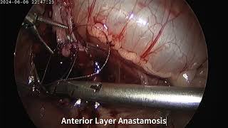 Laparoscopic Pyeloplasty in an Infant [upl. by Hezekiah]