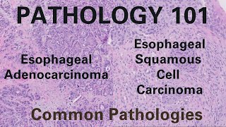 Esophageal Adenocarcinoma and Squamous Cell Carcinoma  Pathology 101 GI Pathology [upl. by Ralston]