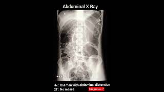 Diagnosis  Abdominal X Ray  Practical case  Radiology [upl. by Asilrac]