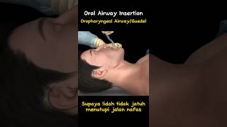 Oropharyngeal Airway [upl. by Aihsilef]