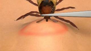 How To Remove A Tick [upl. by Nomaid457]