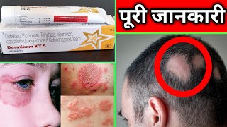 Dermikem Kt5 Cream use in hindi  इस क्रीम के 2 फायदे हैं alopecia areata और दाद खाज खुजली fungal [upl. by Mazur]