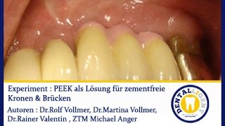 Dentaltechnik  1 Experiment  PEEK als Lösung für zementfreie Kronen amp Brücken [upl. by Delorenzo]