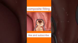 Animation composite filling process cavityfilling localdentistry youtubeshorts ytshortsindia [upl. by Epilef]