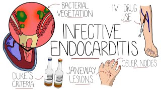 Infective Endocarditis With Duke Criteria amp Pathophysiology [upl. by Southard]