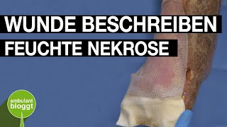 Feuchte Nekrose  Wunde beschreiben  moderne Wundversorgung [upl. by Ryon995]