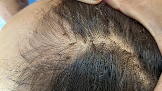 Remove many lice from brown hair  Plucking most of lice from head [upl. by Citarella]