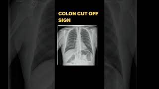 Acute pancreatitis doctor pancreas bowel radiology neet xray medicine abdomen trauma mbbs [upl. by Joris]