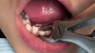 Deciduous Tooth Extraction [upl. by Bathelda]