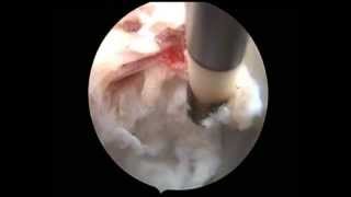 anular tear and repair [upl. by Andrade]