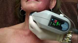 Exilis on Face amp Neck for Skin Tightening with Dr Seiler [upl. by Aiehtela]