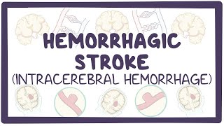 Hemorrhagic stroke intracerebral hemorrhage  causes symptoms diagnosis treatment pathology [upl. by Leod]