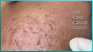 Big Cystic Acne Blackheads Extraction Blackheads amp Milia Whiteheads Removal Pimple Popping [upl. by Nnylram468]