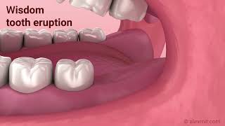 Wisdom tooth eruption 3D Animation [upl. by Huei]