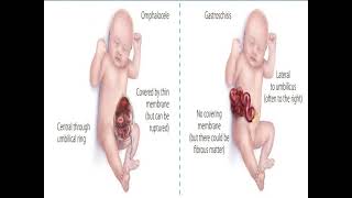 Omphalocele vs Gastroschisis [upl. by Birk724]