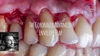 The coronally advanced flap [upl. by Eeralih]