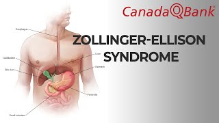 ZollingerEllison syndrome [upl. by Nirak]