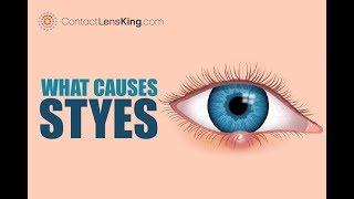 What Are Styes Causes Symptoms and Treatments [upl. by Einre451]