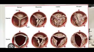 Aortic stenosis 2D and M Mode assessment [upl. by Erna]