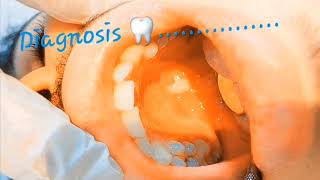 What is your diagnosis8 White patch extending on hard palate premalignant keratotic lesions [upl. by Joya937]