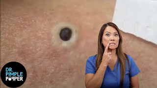 85 Year Old Blackhead Dr Pimple Popper Most Popular Pop of ALL TIME [upl. by Anhsirk]