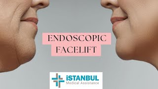 What is Endoscopic Facelift  Plastic and Cosmetic Surgery [upl. by Maddalena]