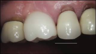 Immediate CeraRoot 16 implant placed by Dr John Masso  5 YEAR FOLLOWUP [upl. by Seaden]