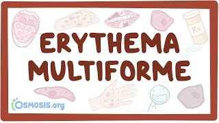 Erythema multiforme  causes symptoms diagnosis treatment pathology [upl. by Nebe]