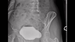 Normal Voiding Cystourethrogram VCUG [upl. by Claud]