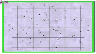 ¿Qué es oligospermia [upl. by Freytag]