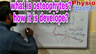 Osteophytes how it is develope [upl. by Akeim300]