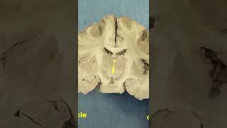 Caudal diencephalon Thalamus and subthalamusneuroanatomy forebrain anatomy brainhumanbrain [upl. by Lobell215]