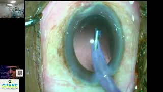 How is cataract Surgery done   Telugu క్యాటరాక్ట్ సర్జరీ ఎలా చేయబడుతుంది [upl. by Atyekram]