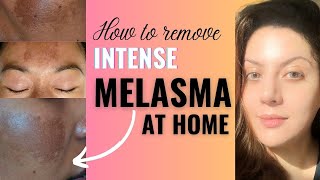 How to Remove Melasma from Face Permanently at Home I Melasma Removal Treatment [upl. by Oiramat]