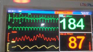 Supraventricular TachycardiaSVT in Cardiac Monitor [upl. by Vasiliu]