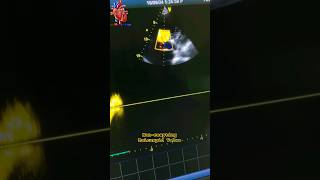 noncoapting Tricuspid Valve echo tricuspid valve heartdisease valve [upl. by Ailahtan]