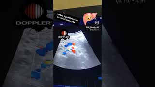 A case of portal hypertension with collaterals channel formationdoppler day 24 [upl. by Yumuk]